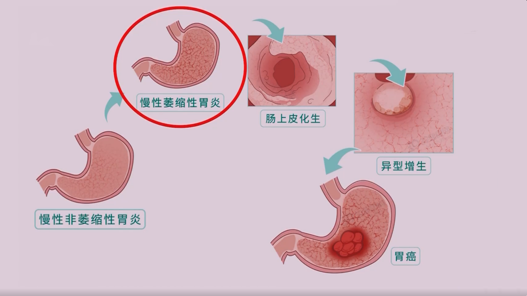 X诊所. 胃癌正在年轻化 “胃”病先防助健康