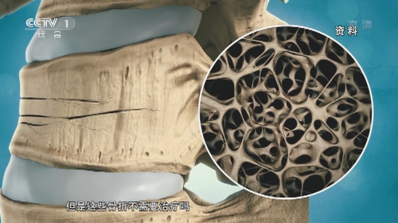 《人口》 20211020 预防骨质疏松要趁早