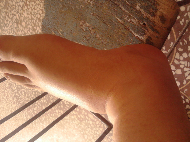 痛风如何治疗好的比较快?