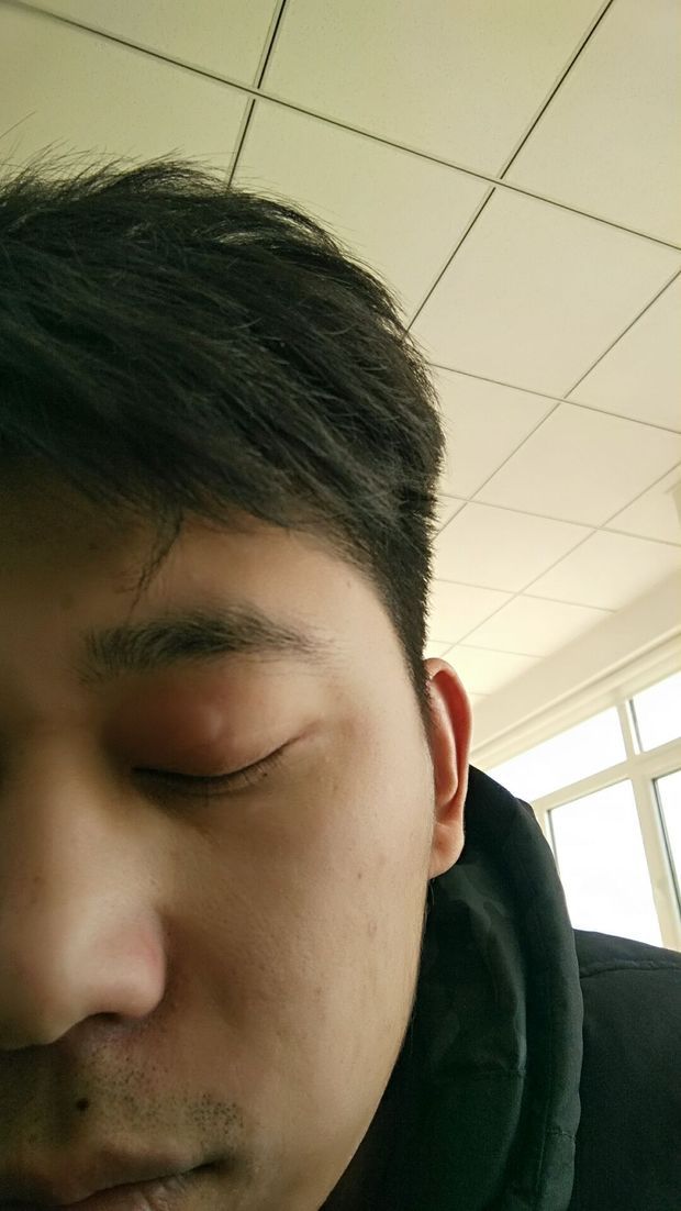 刚刚在公司趴着桌子睡了半小时,醒来看到左边眼皮肿了一块怎么回事.
