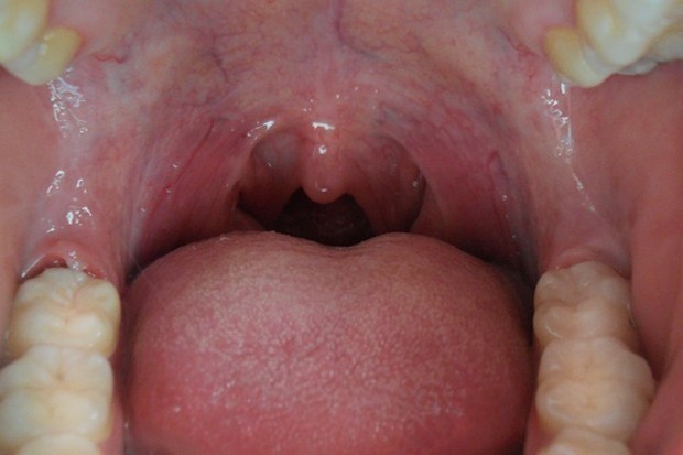 左侧最后边牙龈上长了块肉